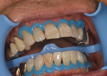 歯の周辺を保護する