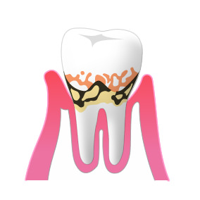 ②歯周病(軽度)