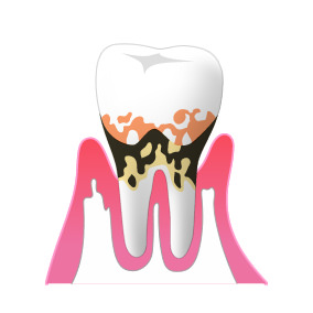 ③歯周病（中度）
