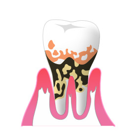 ④歯周病（重度）